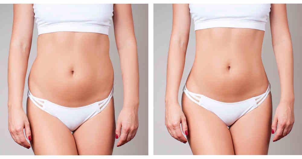 LIPOSUCTION BEFORE AND AFTER PICTURES