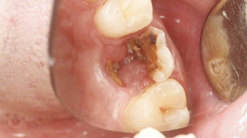 Tủy răng bị hoại tử gây răng gãy vỡ chỉ còn chân răng
