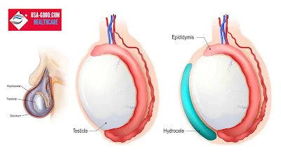What is Hydrocele?