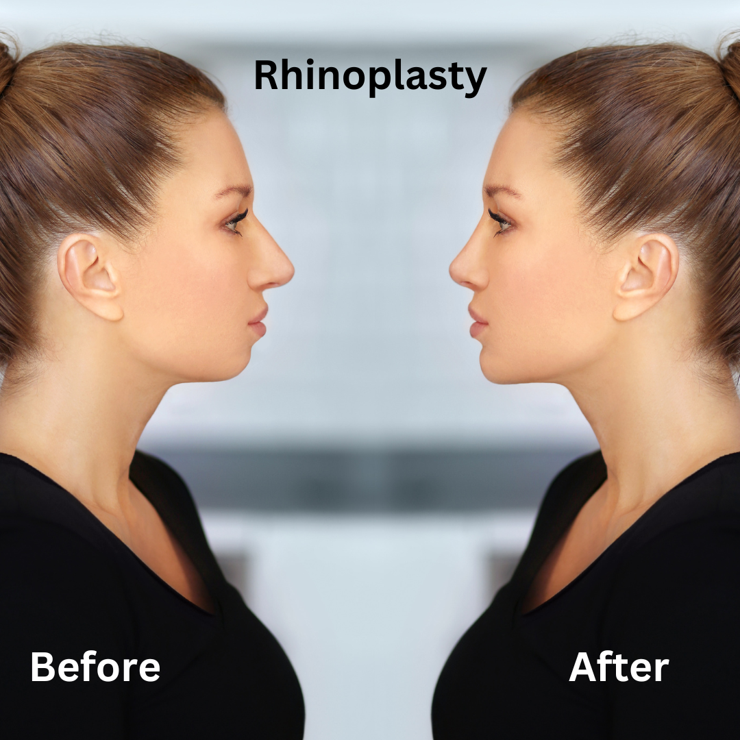 rhinoplasty dubai before/after
