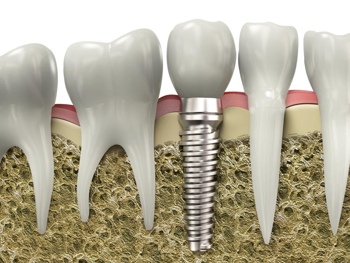 Vancouver dental implants