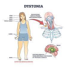 Dystonia.