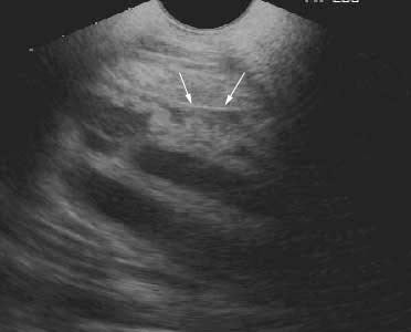 Ultrasonografía transabdominal y transrectal de la placenta en una yegua durante el noveno mes de gestación. La flecha señala la zona de separación placentaria.