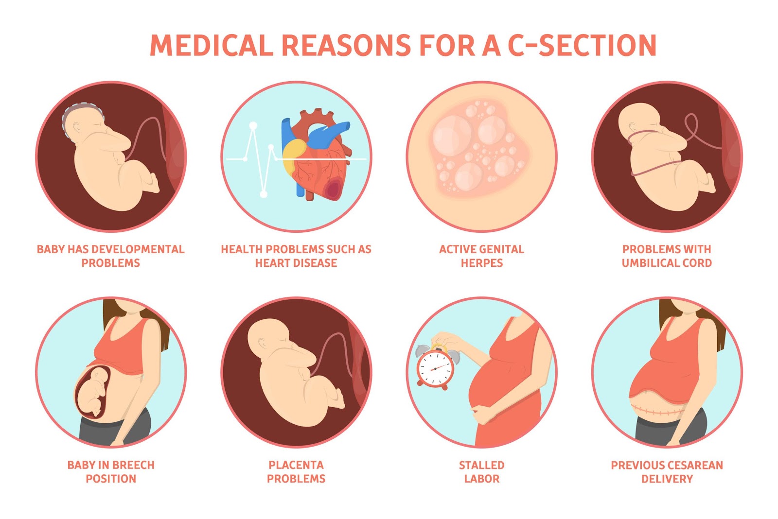 What are the Indications of C SECTION? - Apollo Hospitals Blog