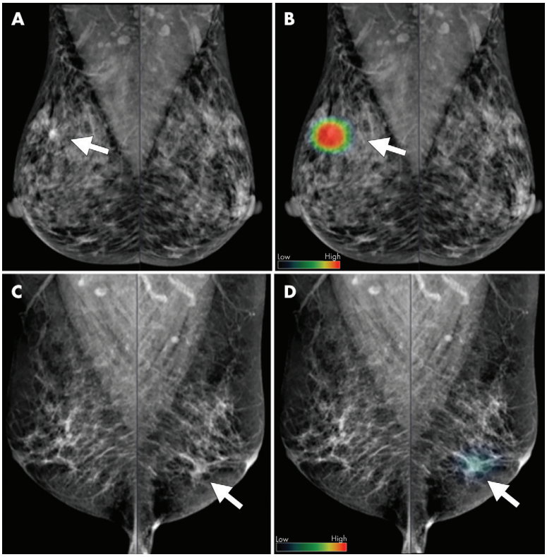 Mamografias médio laterais oblíquas bilaterais em duas mulheres com câncer de mama