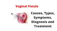 What Is a Vaginal Fistula