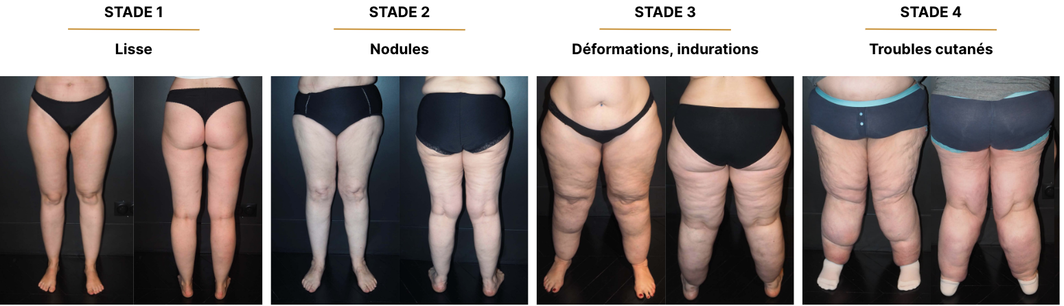 Types and stages of lipedema