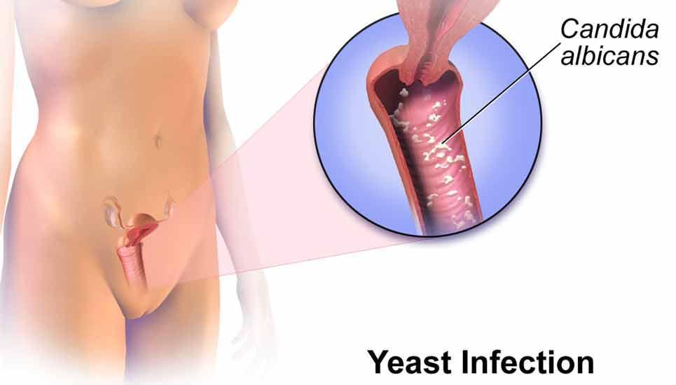 candida yeast infection vaginal