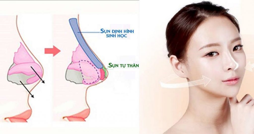 Đối với nâng mũi 4D, đòi hỏi bác sĩ thực hiện phải là người có chuyên môn, nghiệp vụ cao, nhiều năm kinh nghiệm trong nghề.