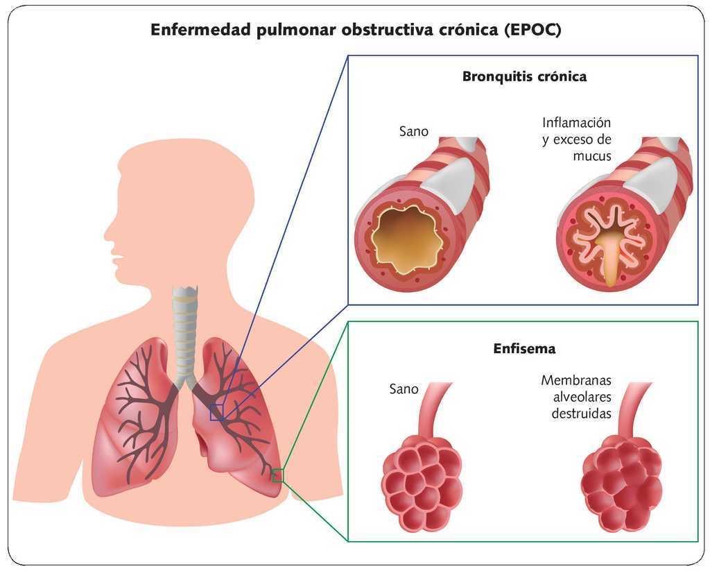 Enfermedad pulmonar obstructiva crónica