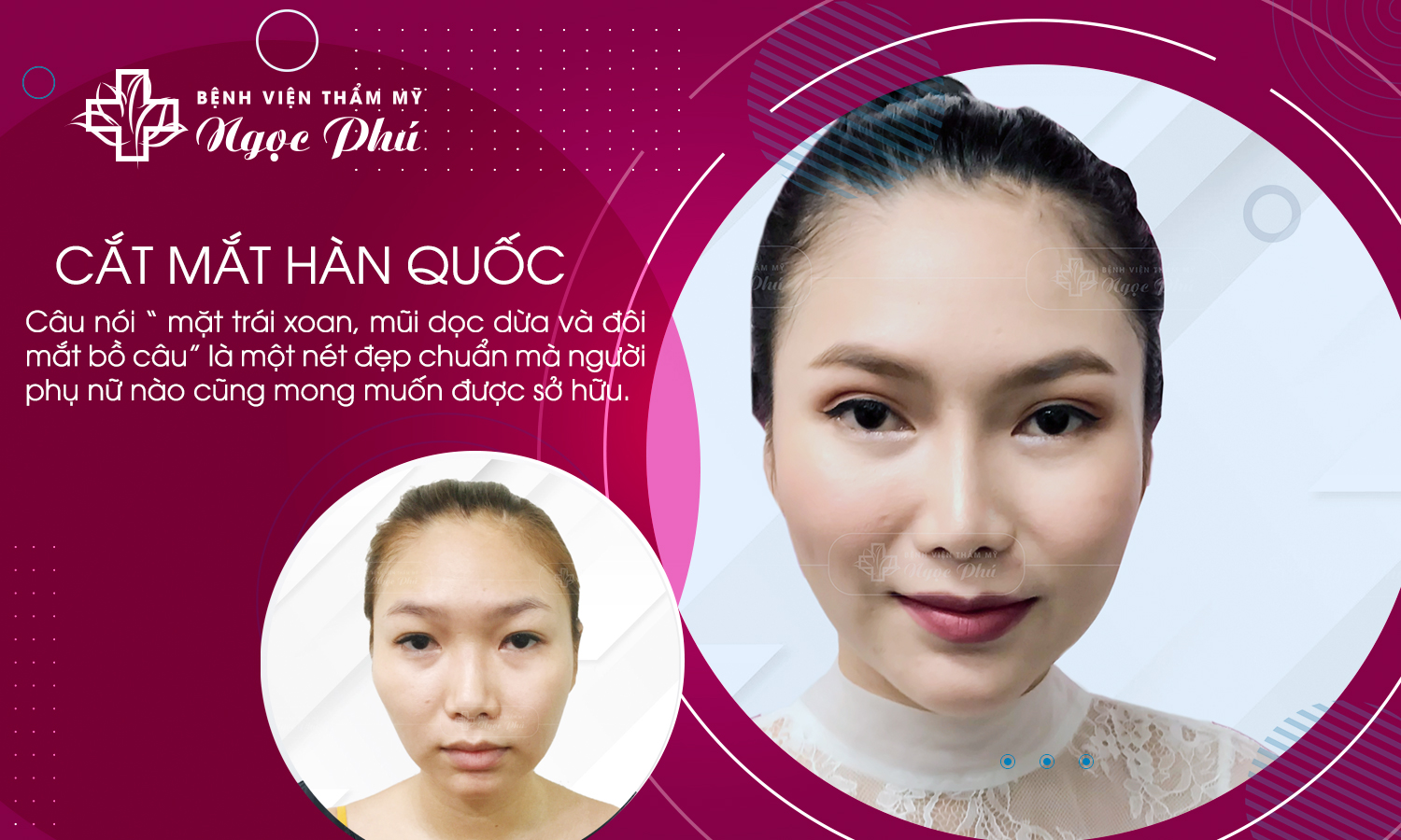 Thẩm Mỹ Việt Nam tự hào là địa chỉ cắt mắt 2 mí Hàn Quốc uy tín, chất lượng hàng đầu TP HCM