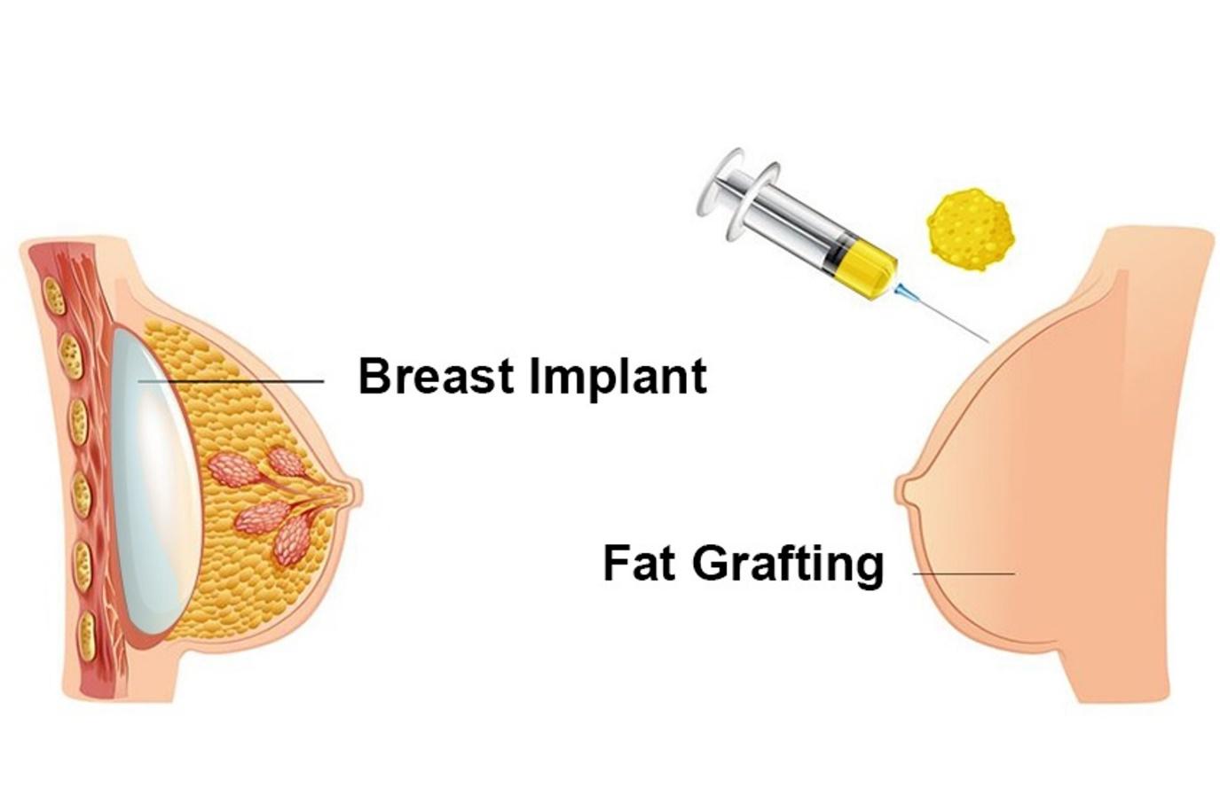 breast implant vs fat grafting
