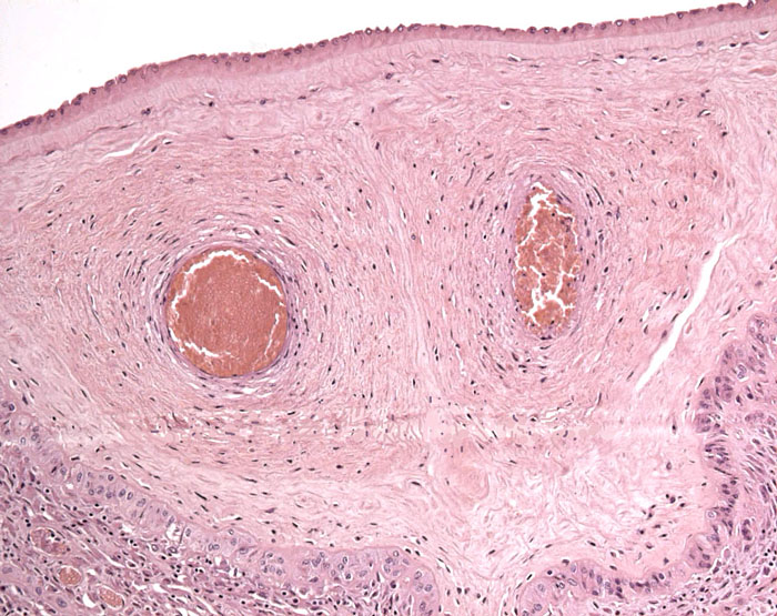 Chorion laeve with two connective fetal blood vessels