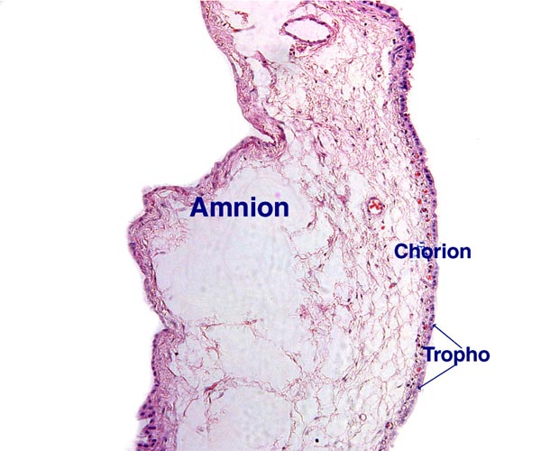 Amnion and chorionic membrane at the edge of the villous tissue