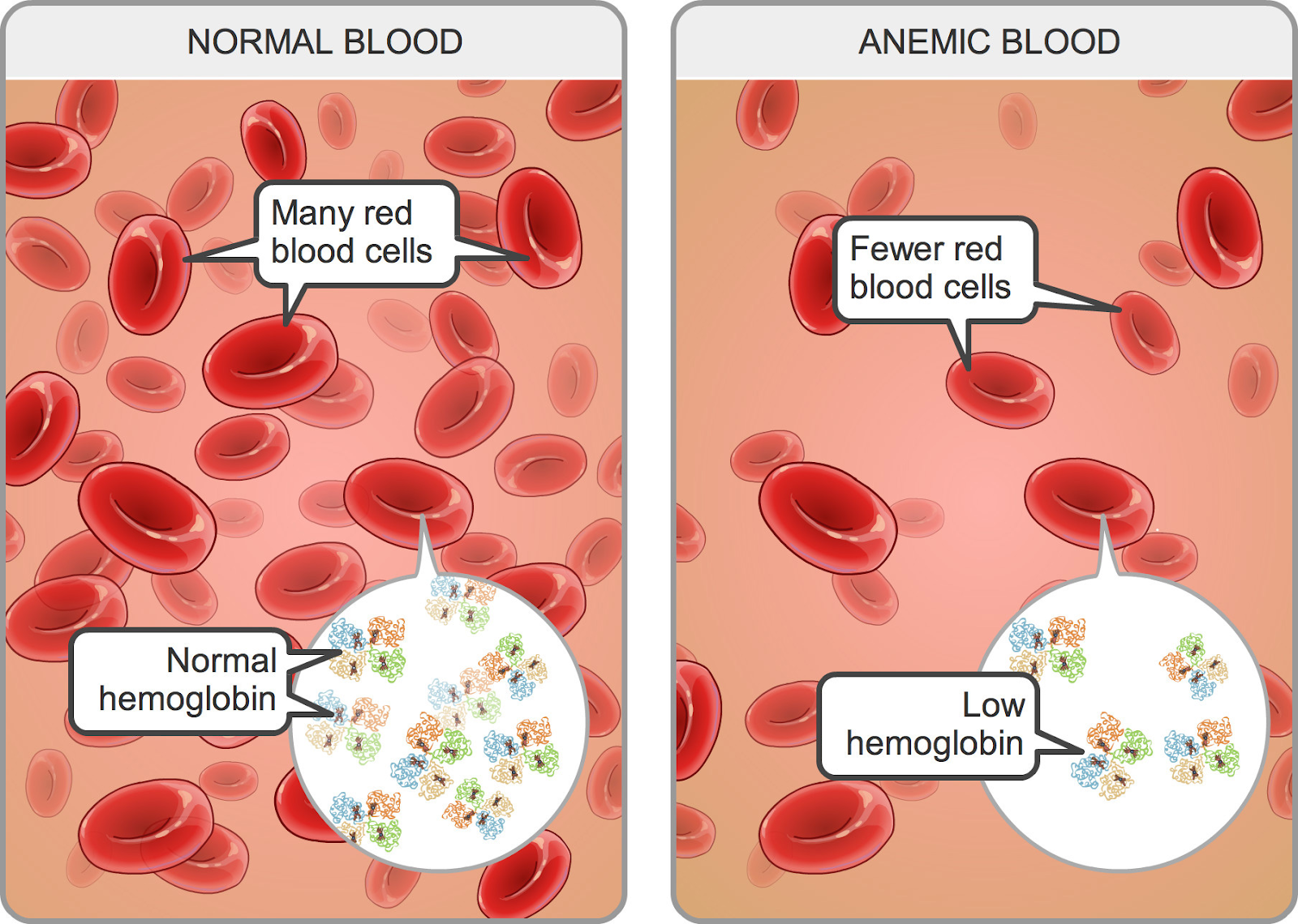 Анемия в моче. Анемия эритроциты. Эритроциты в крови анемия. Железодефицитная анемия норма. Анемия эритроциты и гемоглобин.