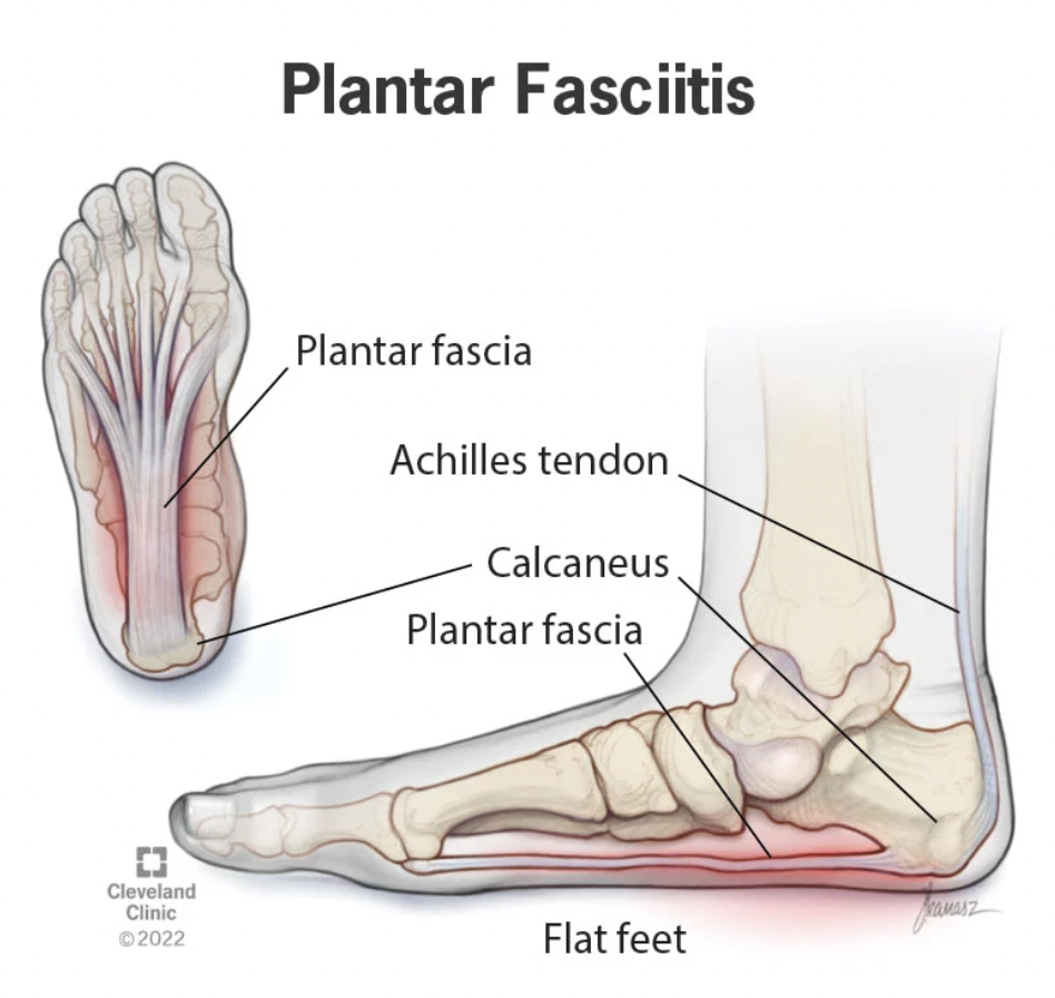 Plantar Fasciitis diagram