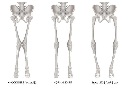 Pes Anserine Bursitis (Knee Pain)