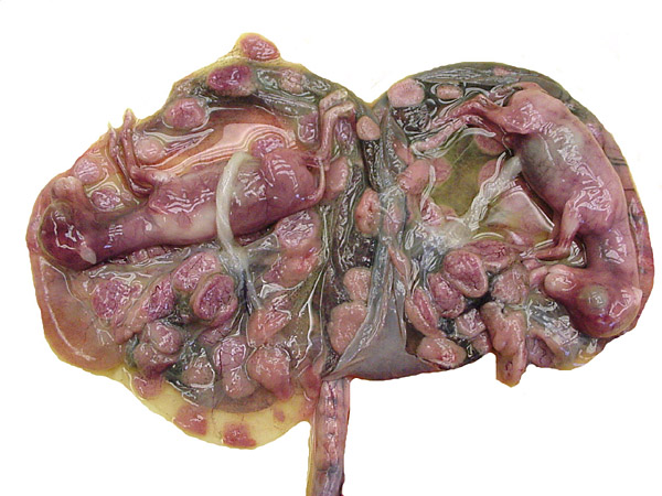 Opened uterus with immature twins and attached placenta