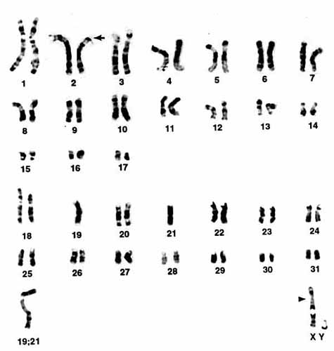 Karyotype of male Somali Wild Ass with 2n=63. The arrow point to a small deletion region of # 2, and the arrowhead is placed next to the centromere of the X-chromosome