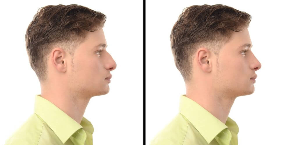 Rhinoplastie avant et après