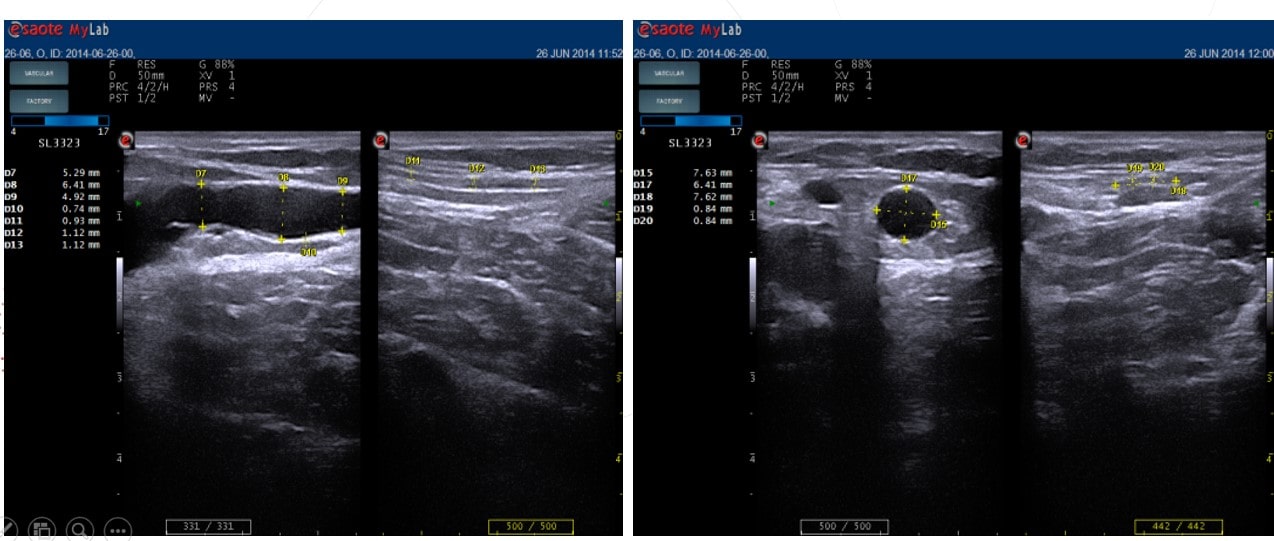 Why is a duplex scanning of the veins of the lower extremities necessary?