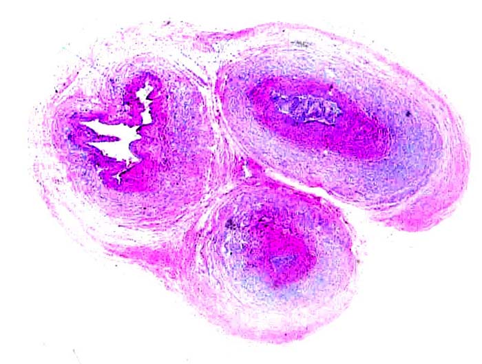 Cross section of the umbilical cord; vein at left.
