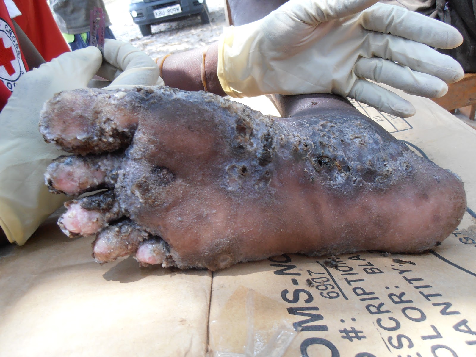 A badly infected foot from sand fleas.