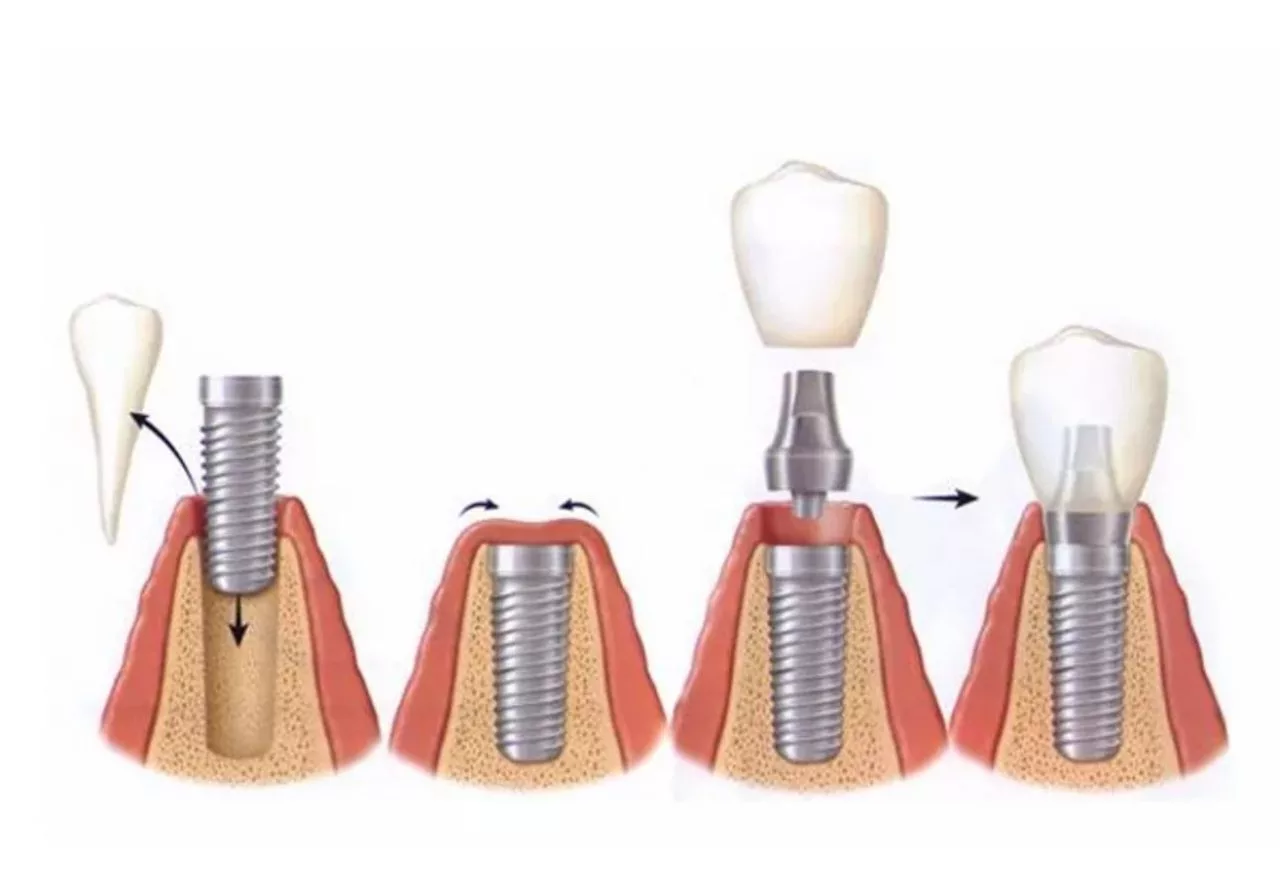 как делают имплантацию зуба
