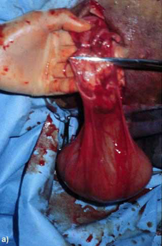 Ovariectomy in a dromedary camel with ovario-bursitis: Transfixion suture at the level of the utero-tubal junction.