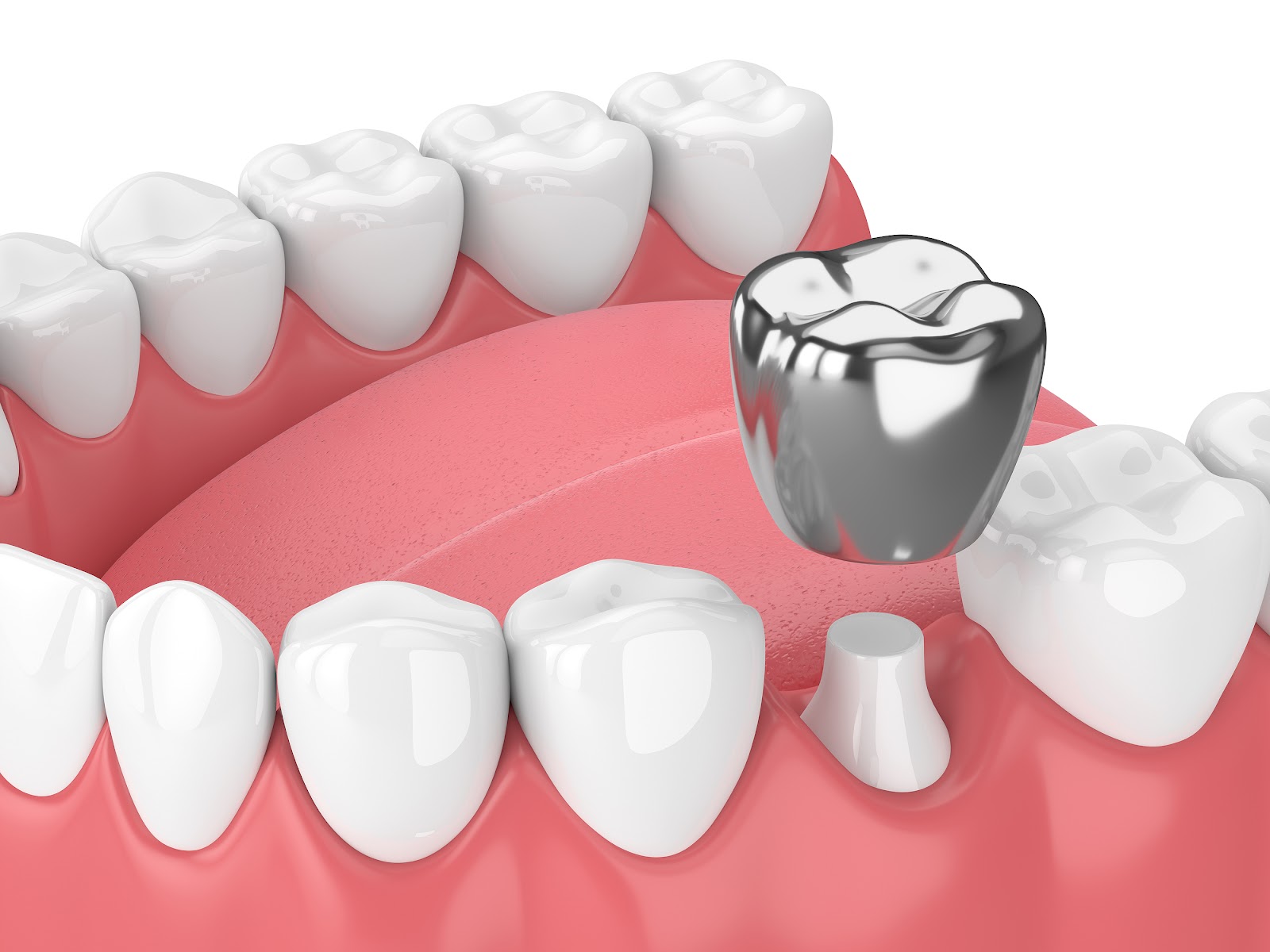 Silver Tooth Crowns | Benefits, Treatment, Side Effects & Cost