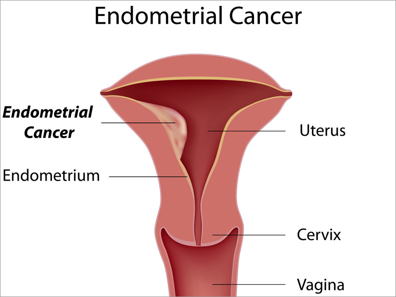 http://cancer-treatment-madurai.com/types-of-cancer-endometrial-cancer.php