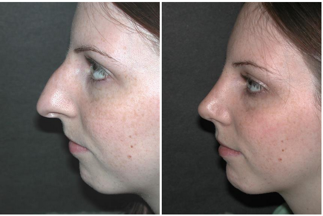 Before and after picture of rhinoplasty procedure