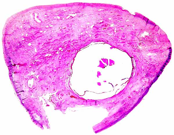Cross section of one maternal ovary whose uterus contained fetus and placenta. There is one cystic follicle, otherwise only scars of former ovulations