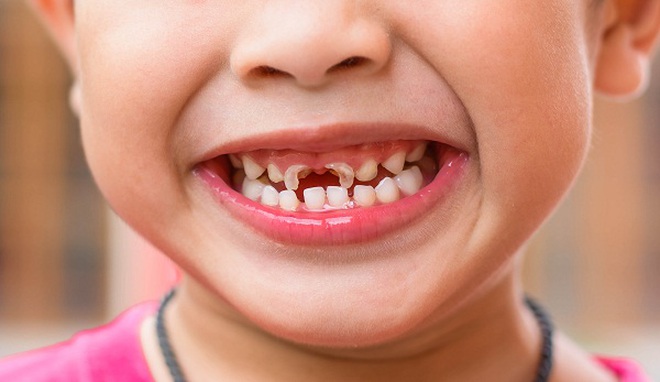 Midkid - giải pháp mới giúp chăm sóc hàm răng xinh của trẻ - 1