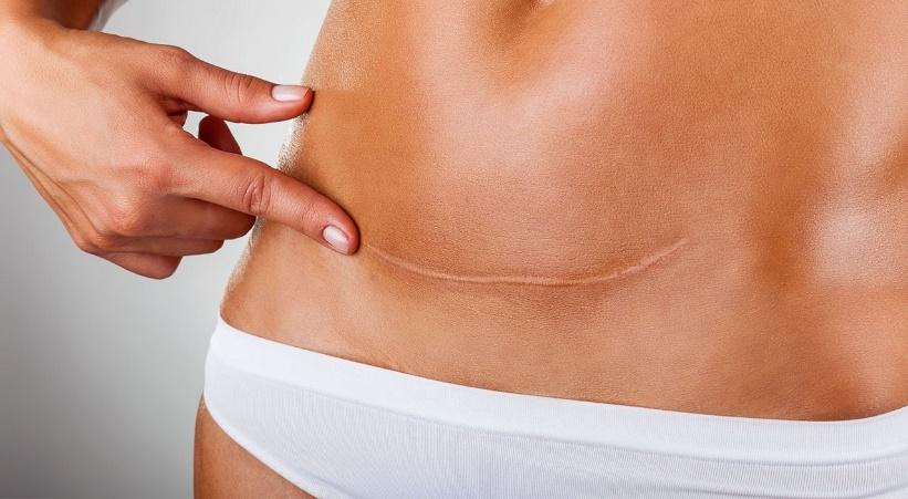 6 Things You Should Do For Your Tummy Tuck Scars and Treatment