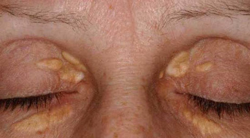 Bệnh lý Xanthelasma - Ban vàng quanh mắt