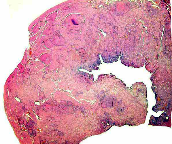 Post partum uterus with deep infiltration of trophoblast into maternal myometrial blood vessels.