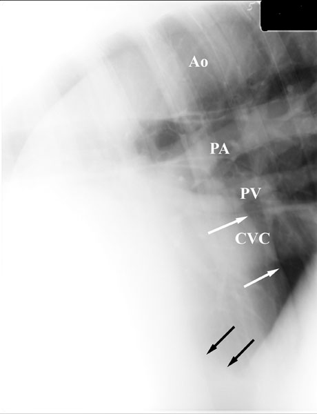 A right lateral radiograph of the ventral caudal thorax of a 750-kg horse (Cassette position C, Fig. 8). The Pulmonary arteries (PA), Pulmonary veins (PV), caudal vena cava (CVC) are seen in relation to the caudal margin of the heart (black arrows). Lung margins at the pleural reflection are seen ventrally (white arrows).