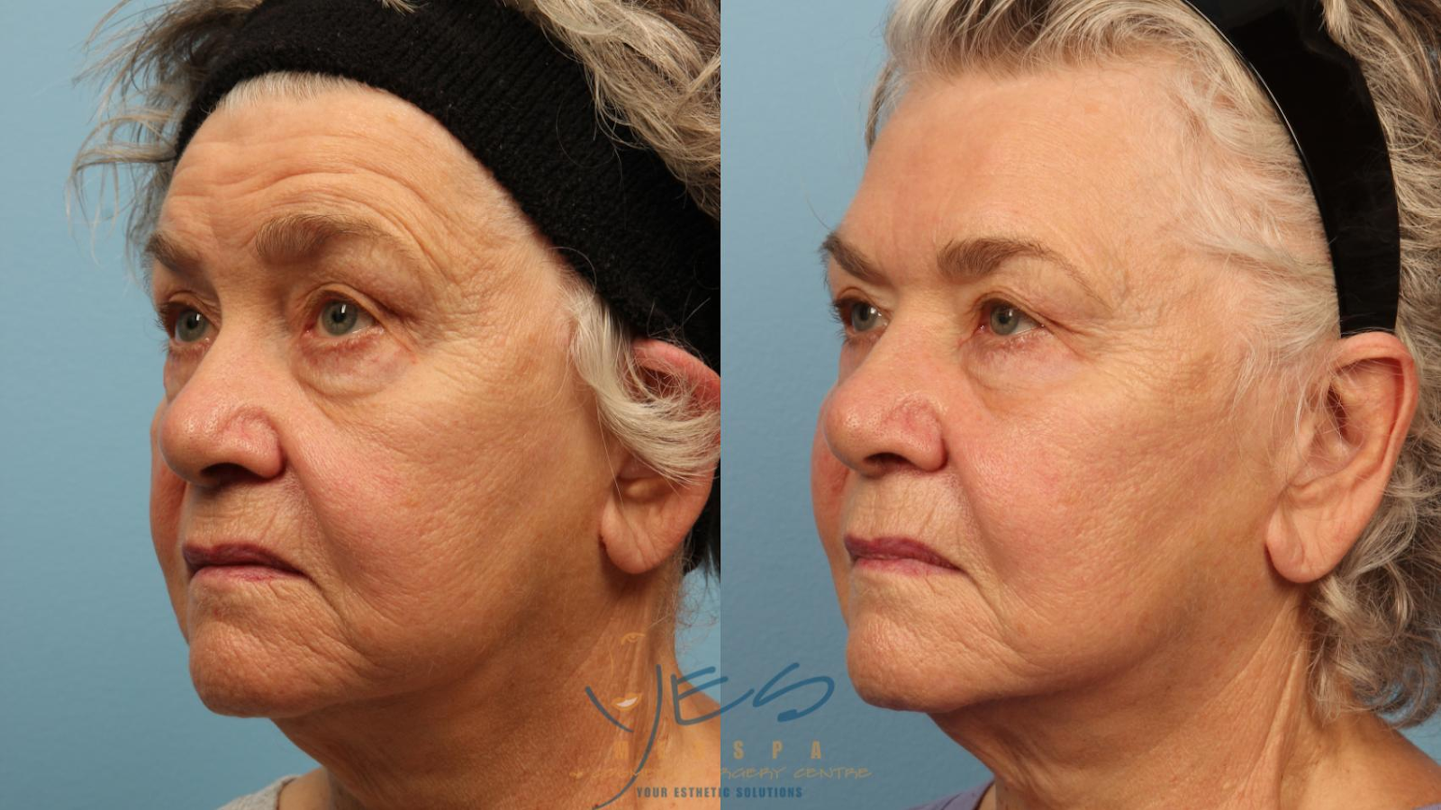 Picture of a before and after treatment of a lady who used botox