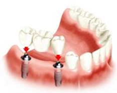 Colocação de dois implantes para preencher a falta de três dentes