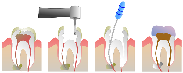 Lấy tủy răng có đau không? gây ảnh hưởng gì 14