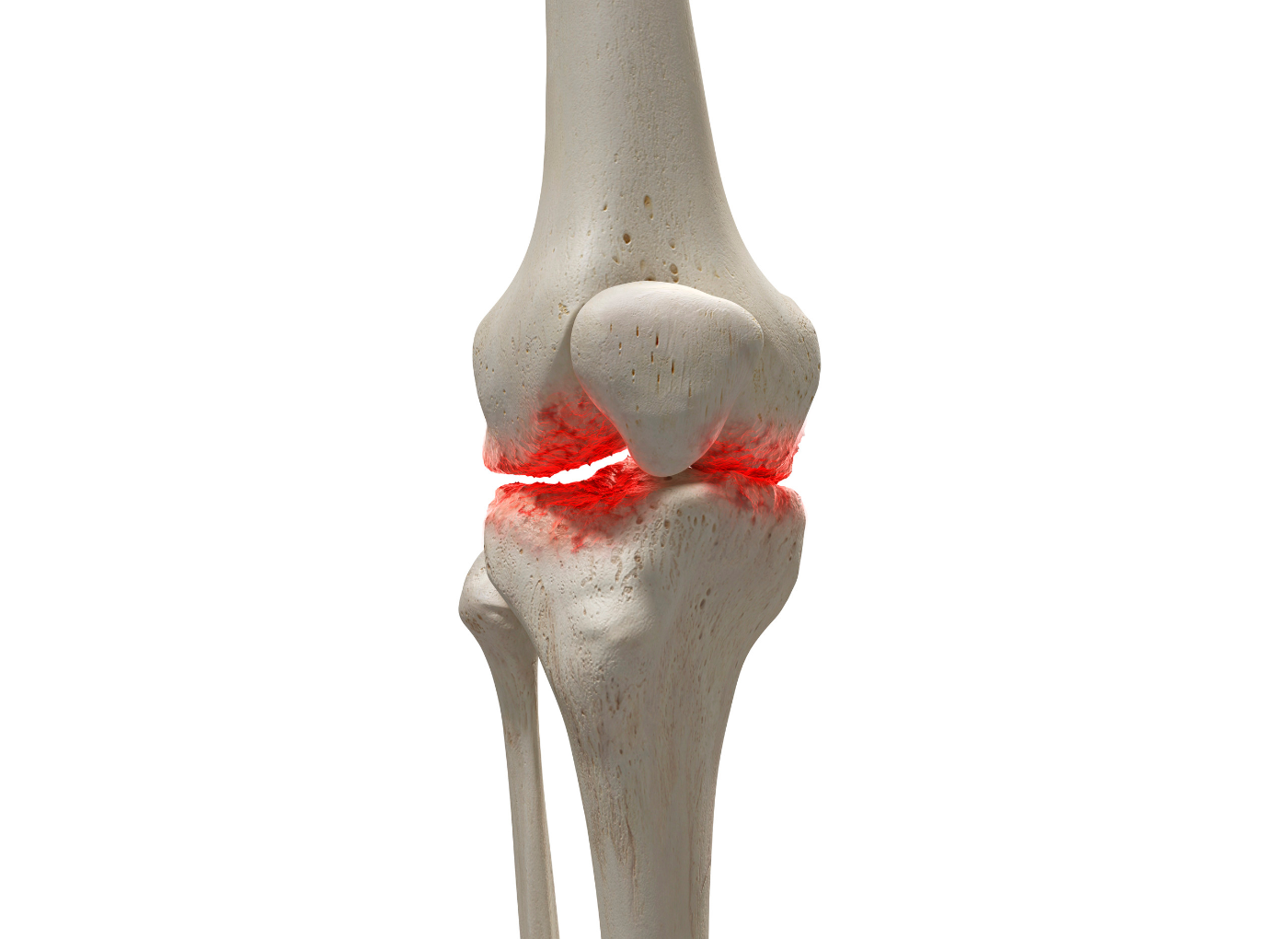 deformáló osteoarthritis terápia a hátfájás hatékony kezelése