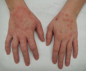Eczema em mãos - Dermatite atópica - Estratégia