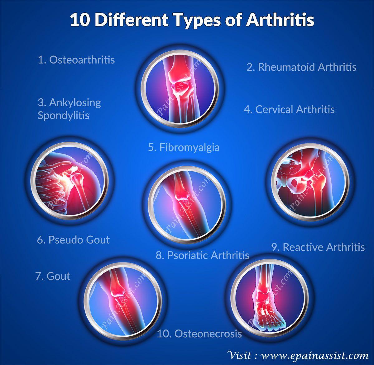 Image result for types of arthritis