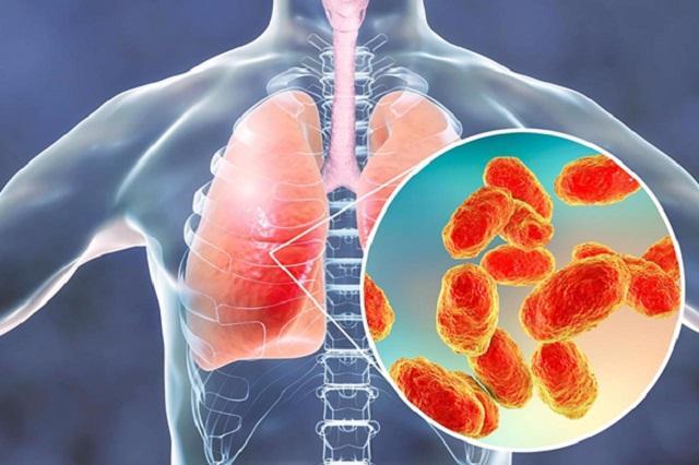 Viêm phổi là gì, chữa được không? Triệu chứng, nguyên nhân và điều trị