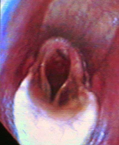 Dynamic collapse of the left arytenoid cartilage with axial deviation of both vocal cords during treadmill exercise.