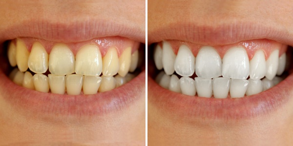 Image result for white teeth before after