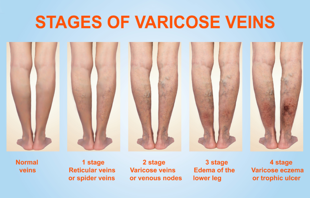 Vein Disease