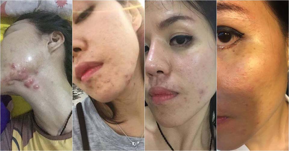 Berof Skincare Acne treatment Lahore