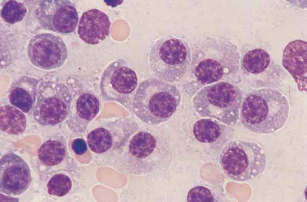 Plasma cells. B lymphocytes differentiate into plasma cells. These cells have an eccentric round nucleus, clumped chromatin, and blue cytoplasm that contains a focal clear zone (100x).